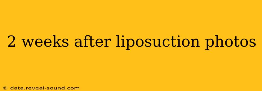 2 weeks after liposuction photos