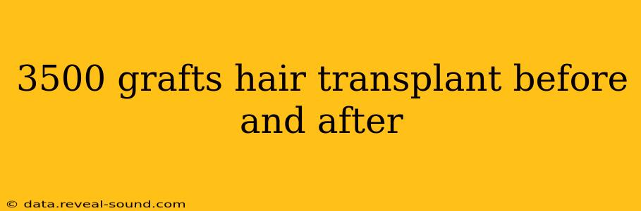 3500 grafts hair transplant before and after