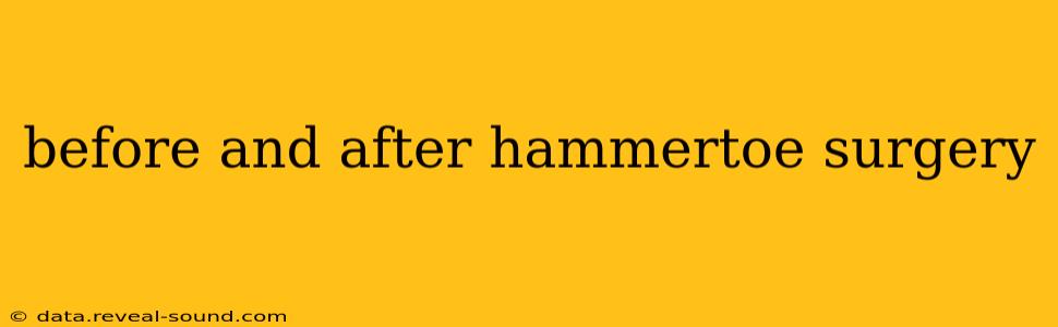 before and after hammertoe surgery