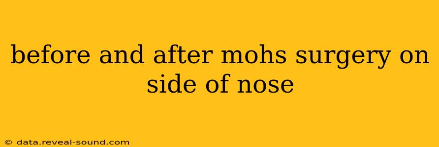 before and after mohs surgery on side of nose
