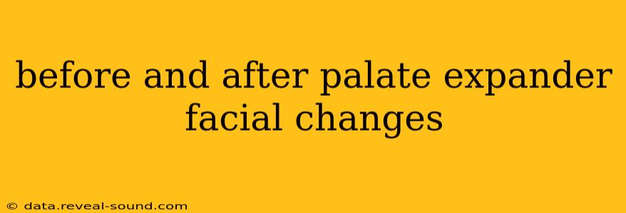 before and after palate expander facial changes