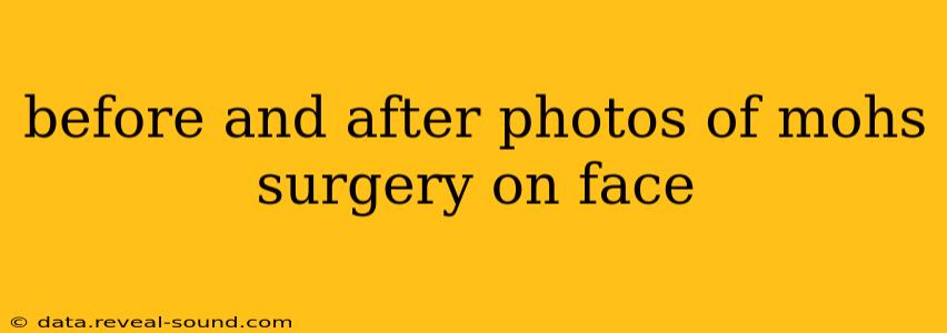 before and after photos of mohs surgery on face