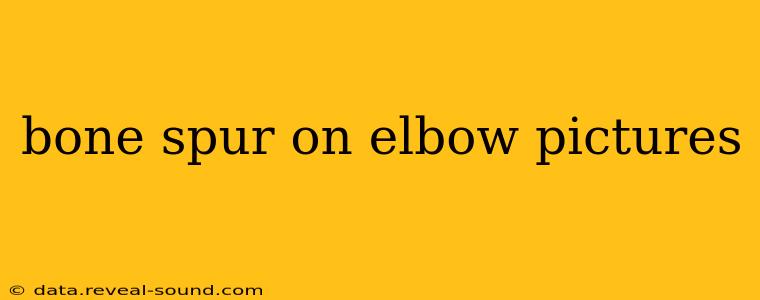 bone spur on elbow pictures