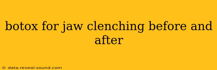 botox for jaw clenching before and after