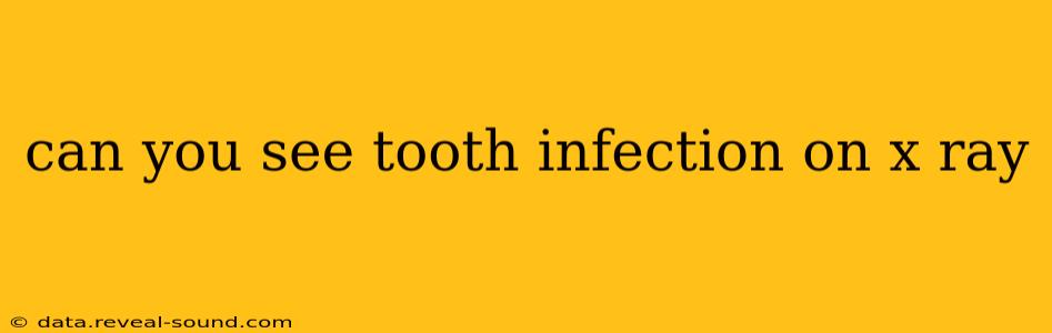 can you see tooth infection on x ray