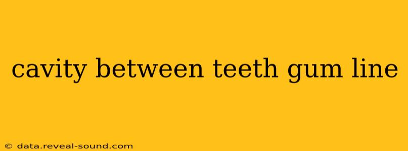 cavity between teeth gum line