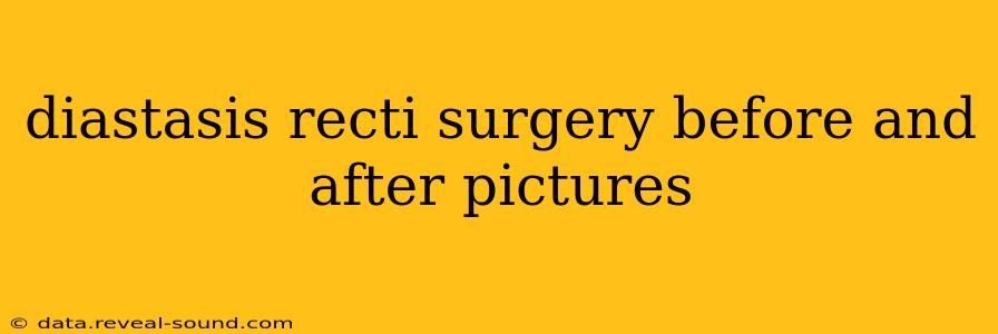 diastasis recti surgery before and after pictures