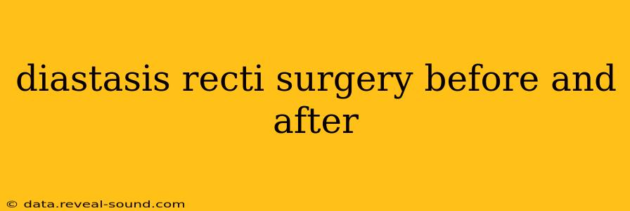 diastasis recti surgery before and after