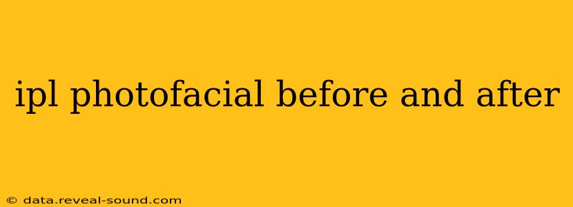 ipl photofacial before and after