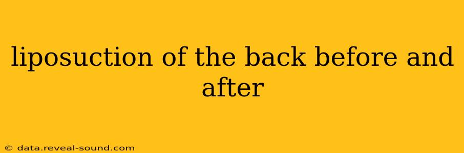liposuction of the back before and after