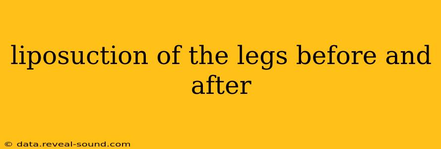 liposuction of the legs before and after