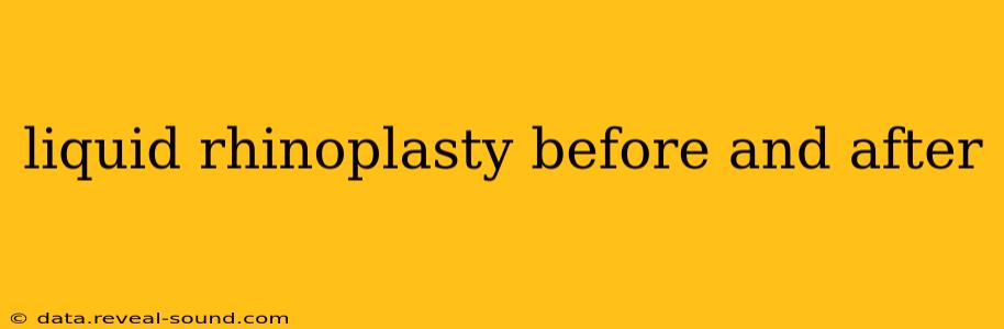 liquid rhinoplasty before and after
