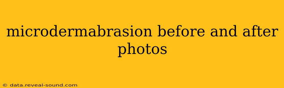 microdermabrasion before and after photos
