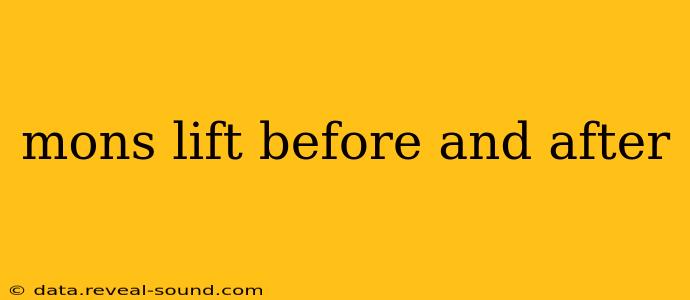mons lift before and after