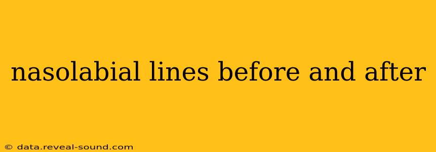 nasolabial lines before and after