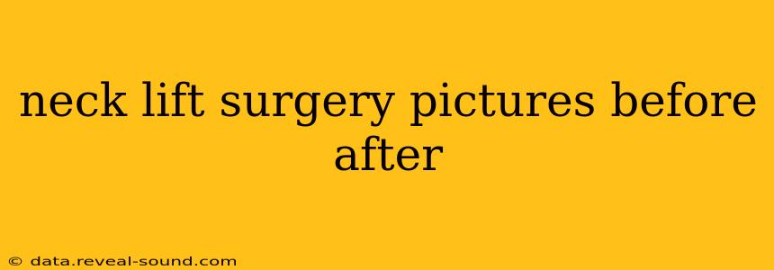 neck lift surgery pictures before after