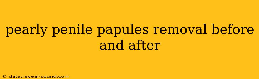 pearly penile papules removal before and after