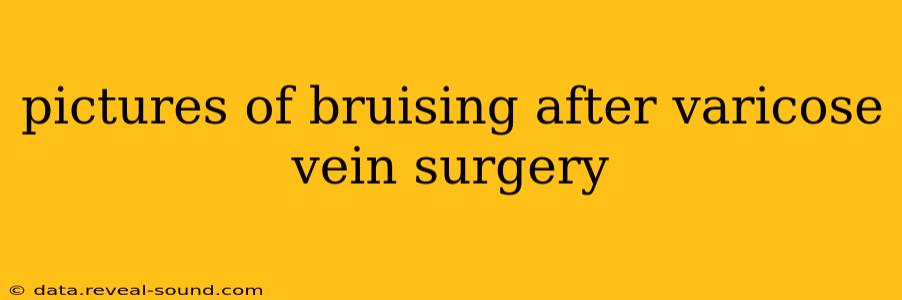 pictures of bruising after varicose vein surgery
