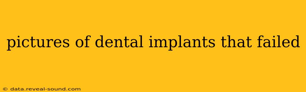 pictures of dental implants that failed
