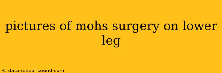 pictures of mohs surgery on lower leg