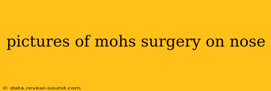pictures of mohs surgery on nose