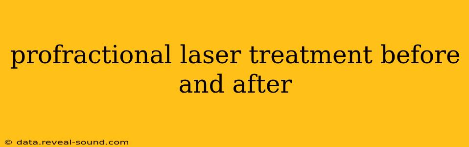 profractional laser treatment before and after