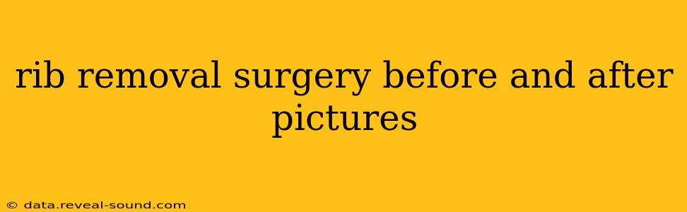rib removal surgery before and after pictures