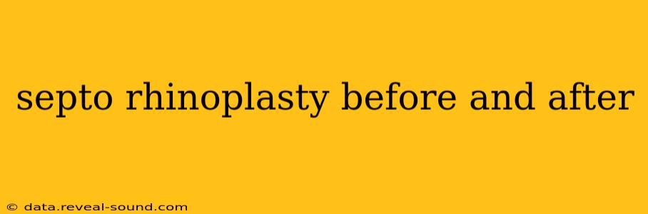 septo rhinoplasty before and after