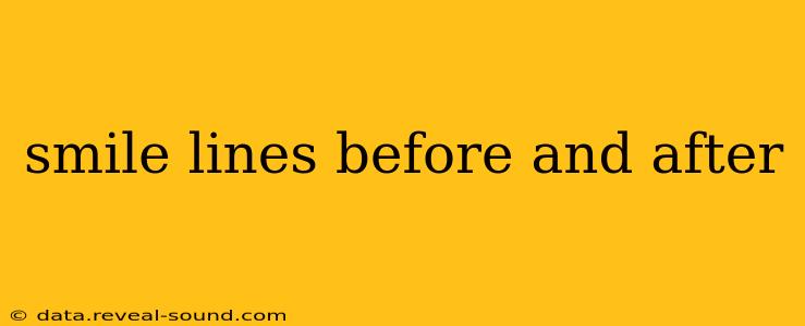 smile lines before and after