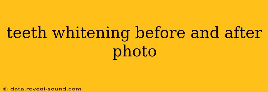 teeth whitening before and after photo