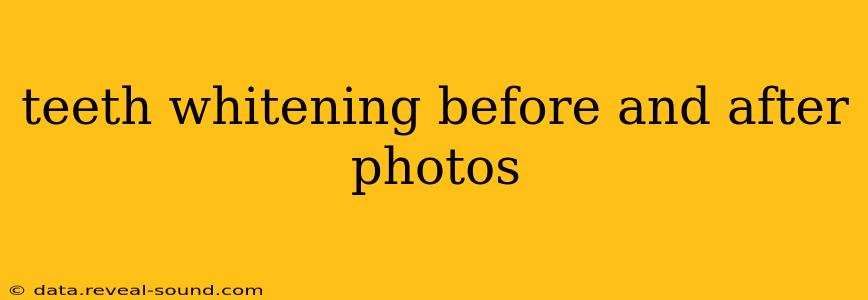 teeth whitening before and after photos