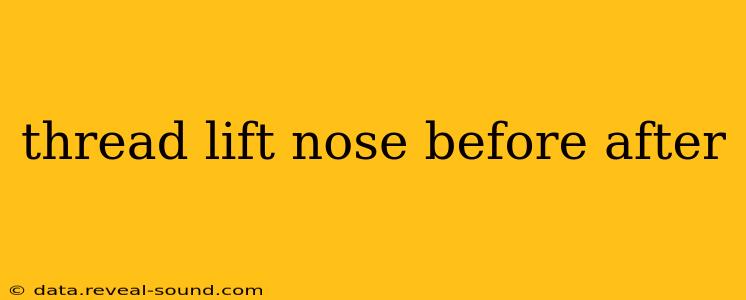 thread lift nose before after