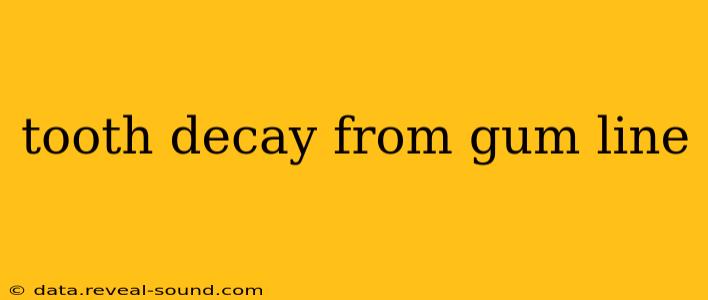 tooth decay from gum line