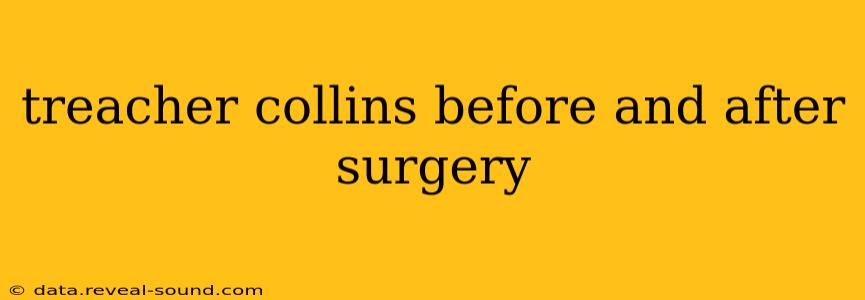 treacher collins before and after surgery