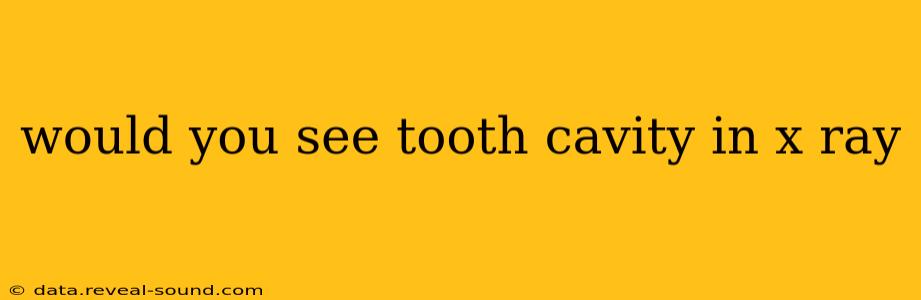 would you see tooth cavity in x ray